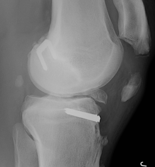 ACL Ellison Lateral